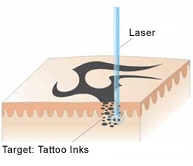 laser laser